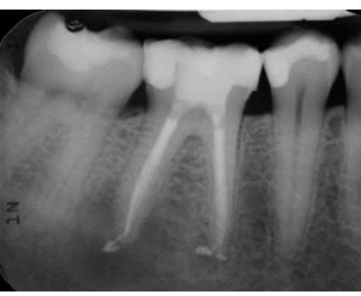Root Canal & Fillings