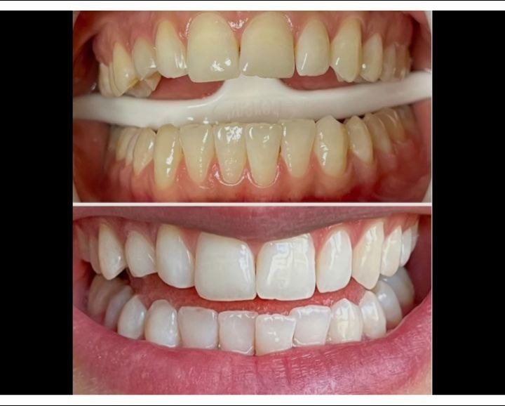 Hollywood Smile & Veneering